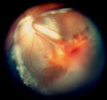 Exudative retinopathy and vitreous hemorrhage in cerebroretinal microangiopathy with calcifications and cysts