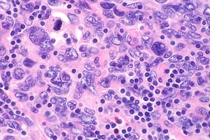 Саркома фолликулярных дендритных клеток - очень высокий mag.jpg