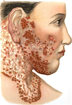 An introduction to dermatology (1905) Lupus vulgaris 2.jpg