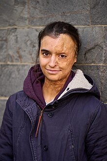 Lena Cornelissen (mit vernarbter linker Gesichtshälfte, den braunen Haaren zusammengebunden und einem leichten Lächeln) mit Winterjacke und lila Pullover, an eine Wand gelehnt.