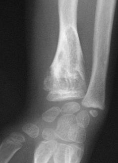 X-ray image showing enchondromas localized in the lower part of the radius of a 7-year-old girl with Ollier disease.