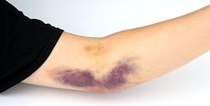 A hematoma caused by a dislodged needle during a plateletpheresis donation.