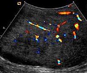 Fig. 19. Fibrous pseudotumor. With color Doppler, a little vascular flow is seen in this fibrous pseudotumor.[citation needed]