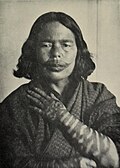 Ainu mit tätowiertem „Ainu-Bart“