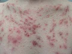 Acne papulopustulosa