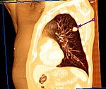 Reconstrução em 3D de uma tomografia computadorizada de tórax mostrando um tumor no pulmão esquerdo (marcado por uma seta)