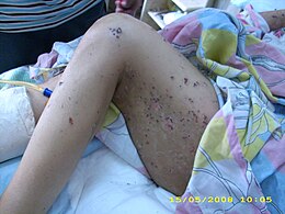 Description de l'image Bullous pemphgoid in a 72 year old bedridden female2.JPG.