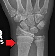 Harris lines in child with growth arrest due to bone disease. GrowthArrestLines.png