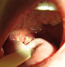 mono pharyngitis