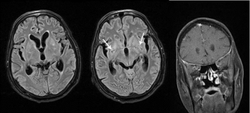 Disseminated cryptococcal meningitis Meningitis criptococica diseminada.png