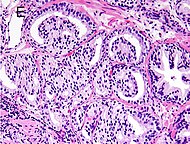 Микрофотография рака простаты по шкале Глисона 8 (4 + 4) с гломерулоидными железами.jpg