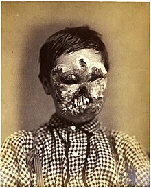 Face disfigured by syphilis Syphilis.jpg