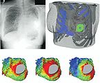 Patient-specific modeling in a patient with congenital heart disease.