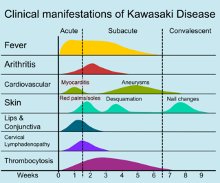 Signs and symptoms and time course of Kawasaki disease Kawasakidiseasemanifestations.png