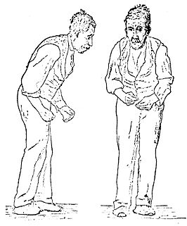 Illustratie van de ziekte van Parkinson door Sir William Richard Gowers uit A Manual of Diseases of the Nervous Systemin 1886