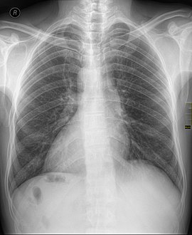 أشعة سينية لشخص مصاب بالقلب اليميني و تظهر قمة القلب في اليمين