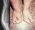 Miniatura para Síndrome de hipoplasia cúbital-pie de langosta