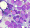 Bone marrow aspirate showing acute myeloid leukemia