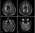 Miniatura para Arteriopatía cerebral autosómica dominante con infartos subcorticales y leucoencefalopatía