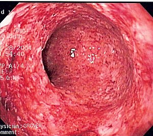 Endoscopic image of severe Crohn's colitis sho...