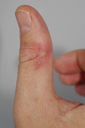 Infection of the skin as a complication of ato...