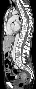 Sagittal rekonstruierte CT, Weichteilfenster. Neben den Metastasen in der Wirbelsäule, die teilweise nach hinten in den Spinalkanal einwachsen, auch Metastasen im Brustbein. Zusätzlich Lebermetastasen.
