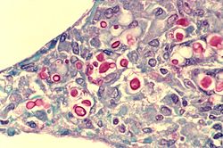 C. neoformans seen in the lung of a patient with AIDS. Mucicarmine stain is used in this case, staining the inner capsule of the organism red. Cryptococcosis of lung in patient with AIDS. Mucicarmine stain 962 lores.jpg