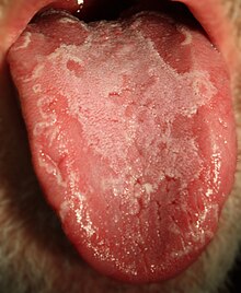 Geographic tongue (benign migratory glossitis)