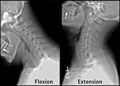 X-ray na kashin mahaifa a cikin jujjuyawa da tsawo