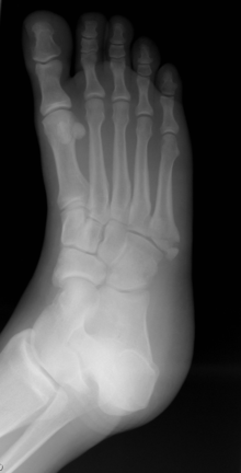 Free, official information about 2009 (and 2013) ICD-9-CM diagnosis code V54. 19. 2013 ICD-10-CM S22.20XD Unspecified fracture of sternum, subsequent.