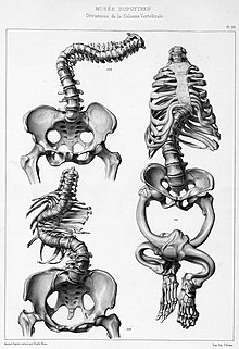 Déformations de la colonne vertébrale.