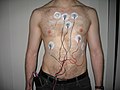 EKG Holter se sedmi elektrodami. Lze si také všimnout, že pacientova místa, kde dochází ke styku elektrod s kůží, jsou řádně oholena.