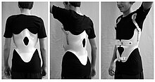 Modern brace for the treatment of a thoracic kyphosis. The brace is constructed using a CAD/CAM device.[17]