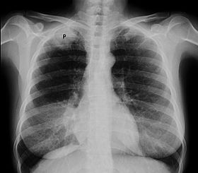 صورة بالأشعة السينية على الصدر يبين ورم بانكوست ( موضح بحرف P ، سرطان الرئة ذو الخلايا غير الصغيرة، الرئة اليمنى) لرئة امرأة مدخنة تبلغ من العمر 47 عاماً.