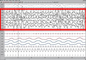 Stage N3 sleep; EEG highlighted by red box. Th...