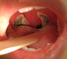 Tonsils After Tonsillectomy