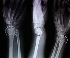 Colles fracture.JPG