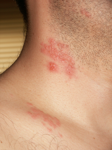 http://upload.wikimedia.org/wikipedia/commons/thumb/d/dc/Herpes_zoster_neck.png/360px-Herpes_zoster_neck.png?uselang=de