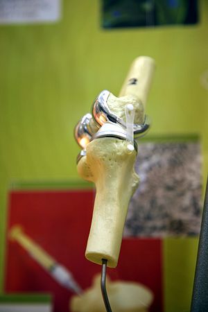 Model demonstrating parts of an artificial knee