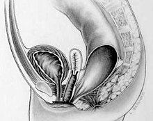 Rectovestibular fistula in females.jpg