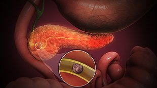 3D Animation Medical de Pancreatitis Acute