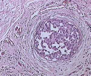 Ductal carcinoma in sity (DCIS)