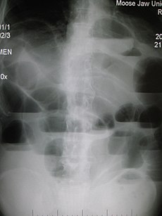 Partial Obstruction Of Bowel Symptoms
