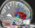 Vignette pour Stimulation cérébrale profonde