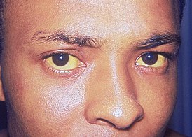 Пожелтение кожи и белков глаз (иктеричность), вызванное гепатитом A.