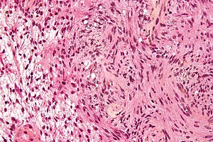Schwannoma - Antoni A and B - very high mag.jpg
