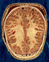 Cortical folds and white matter in horizontal bisection of head Visible Human head slice.jpg
