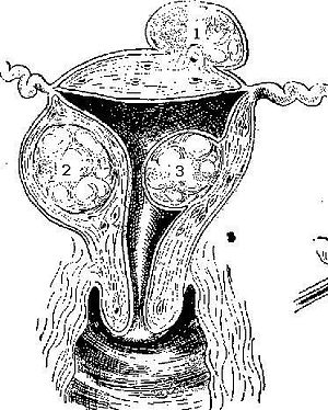 Uterine fibroids Picture