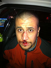 From commons.wikimedia.org/wiki/File:George_Zimmerman_front_of_head.jpg: George Zimmerman