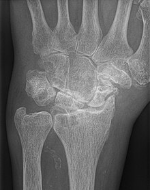 AP wrist x-ray demonstrating Stage III scapholunate advanced collapse
